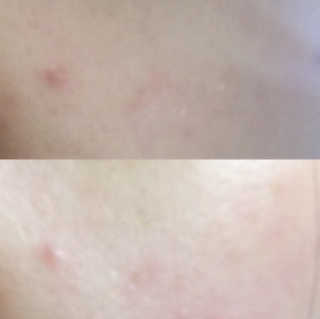 카미안느 AC메디 진정앰플 — 5점을 준 리뷰어가 2018년 5월 올린 사용 사진