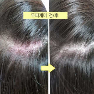Dr.메디션 지긋지긋한 두피가려움, 지루성두피 세보레아샴푸 — 4점을 준 리뷰어가 2019년 6월 올린 사용 사진