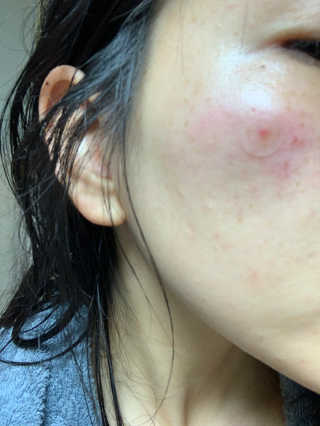 캐치미패치 트러블 스팟패치 — 4점을 준 리뷰어가 2020년 2월 올린 사용 사진