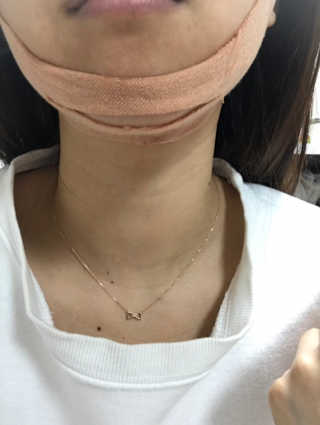 아이디플라코스메틱 아이디 페이스핏 마이너스 밴드 — 5점을 준 리뷰어가 2020년 1월 올린 사용 사진