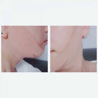 아이디플라코스메틱 아이디 페이스핏 마이너스 밴드 — 3.5점을 준 리뷰어가 2019년 12월 올린 사용 사진