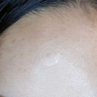 캐치미패치 트러블 스팟패치 — 5점을 준 리뷰어가 2020년 2월 올린 사용 사진