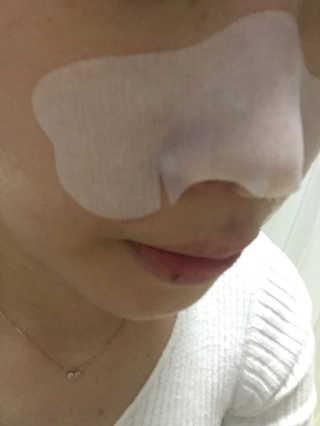 나이팅게일 TAKO PACK NOSE [문어코팩] — 2.5점을 준 리뷰어가 2017년 4월 올린 사용 사진