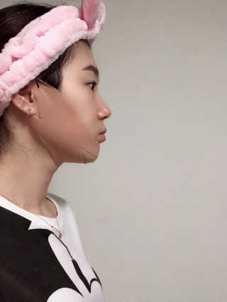 아이디플라코스메틱 아이디 페이스핏 마이너스 밴드 — 3.5점을 준 리뷰어가 2019년 12월 올린 사용 사진