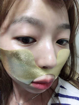 [스케덤] 상악밴드 — 3.5점을 준 리뷰어가 2019년 7월 올린 사용 사진