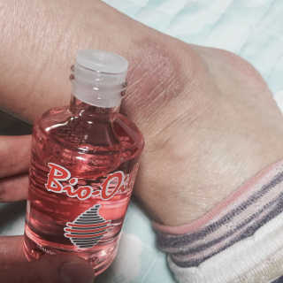 Bio-oil(바이오오일) 바이오오일(Bio-oil) — 3점을 준 리뷰어가 2016년 12월 올린 사용 사진