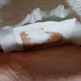 메디테라피 더마 릴렉스 힐링패치 — 2.33점을 준 리뷰어가 2018년 4월 올린 사용 사진