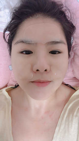 아이디플라코스메틱 아이디 페이스핏 플러스 패치 — 3.5점을 준 리뷰어가 2019년 10월 올린 사용 사진