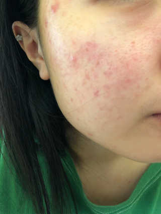 보타니티 [홍]조[진]정[결]케어 플라본 세럼 — 4.33점을 준 리뷰어가 2018년 5월 올린 사용 사진