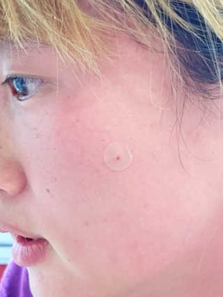캐치미패치 트러블 스팟패치 — 5점을 준 리뷰어가 2020년 1월 올린 사용 사진