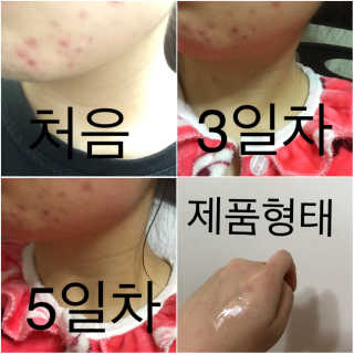 본비반트 티 솔루션 안티 블레미쉬 스팟 에센스 — 4.5점을 준 리뷰어가 2017년 3월 올린 사용 사진