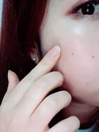 캐치미패치 트러블 스팟패치 — 5점을 준 리뷰어가 2019년 12월 올린 사용 사진