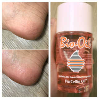 Bio-oil(바이오오일) 바이오오일(Bio-oil) — 3.5점을 준 리뷰어가 2017년 1월 올린 사용 사진