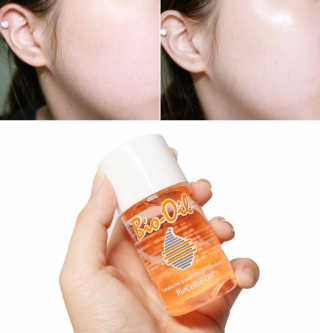 Bio-oil(바이오오일) 바이오오일 — 5점을 준 리뷰어가 2016년 10월 올린 사용 사진