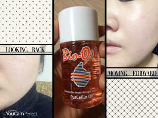 Bio-oil(바이오오일) 바이오오일 — 4.5점을 준 리뷰어가 2016년 10월 올린 사용 사진