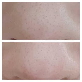 [메디필]엑스트라 슈퍼9 250ml+화장솜40ea — 5점을 준 리뷰어가 2020년 4월 올린 사용 사진