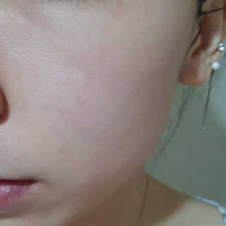 쏘내추럴 레드 필 팅글 세럼 오리지널 — 5점을 준 리뷰어가 2019년 8월 올린 사용 사진