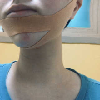 아이디플라코스메틱 아이디 페이스핏 마이너스 밴드 — 4점을 준 리뷰어가 2019년 10월 올린 사용 사진