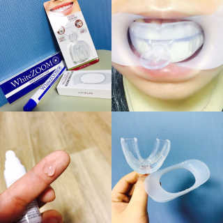라포랩 laforlab 라포랩 화이트줌 치아미백제&개구기 — 4점을 준 리뷰어가 2017년 2월 올린 사용 사진
