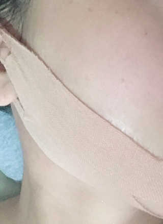 아이디플라코스메틱 아이디 페이스핏 마이너스 밴드 — 3점을 준 리뷰어가 2019년 9월 올린 사용 사진