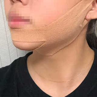 아이디플라코스메틱 아이디 페이스핏 마이너스 밴드 — 5점을 준 리뷰어가 2019년 11월 올린 사용 사진