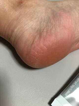 케라셀 풋크림 케라셀 인텐시브 풋 리페어 — 5점을 준 리뷰어가 2019년 11월 올린 사용 사진