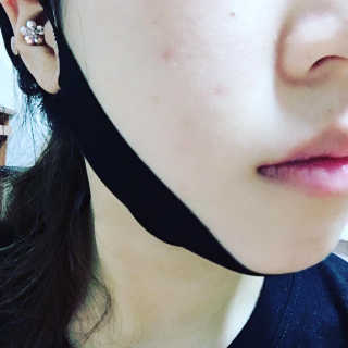 프리티스킨 디자인 유어 뷰티 브이라인 패치 — 3점을 준 리뷰어가 2019년 6월 올린 사용 사진