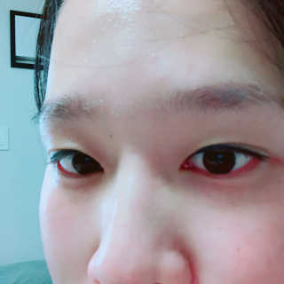 나이팅게일 토닝 필링패드(티트리) — 5점을 준 리뷰어가 2018년 2월 올린 사용 사진