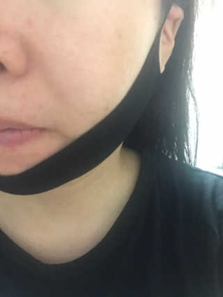 프리티스킨 디자인 유어 뷰티 브이라인 패치 — 4점을 준 리뷰어가 2019년 6월 올린 사용 사진