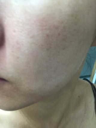 닥터헤디슨 헤디슨 아하 소프트 필링 패드 — 5점을 준 리뷰어가 2019년 9월 올린 사용 사진