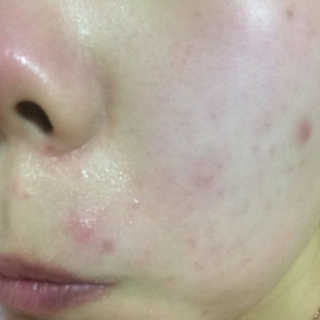 본비반트 티 솔루션 안티 블레미쉬 스팟 에센스 — 5점을 준 리뷰어가 2017년 3월 올린 사용 사진