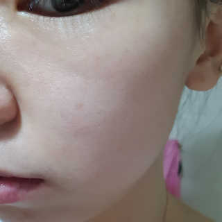쏘내추럴 레드 필 팅글 세럼 오리지널 — 5점을 준 리뷰어가 2019년 8월 올린 사용 사진