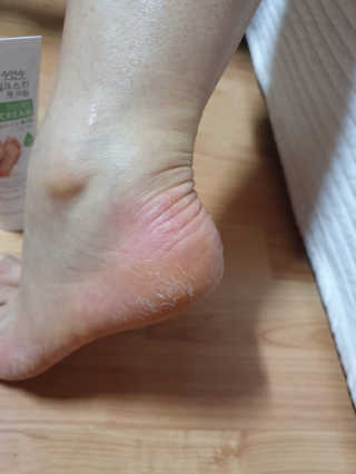 (주)에네스티 에네스티 수안수 실크스킨 풋크림 1+1 — 4점을 준 리뷰어가 2019년 11월 올린 사용 사진