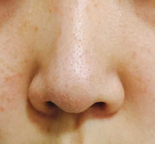 나이팅게일 TAKO PACK NOSE [문어코팩] — 5점을 준 리뷰어가 2017년 5월 올린 사용 사진