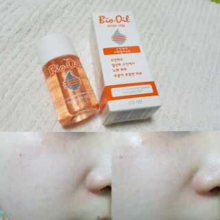 Bio-oil(바이오오일) 바이오오일 — 5점을 준 리뷰어가 2016년 10월 올린 사용 사진
