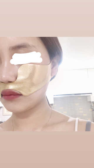[스케덤] 상악밴드 — 4.5점을 준 리뷰어가 2019년 5월 올린 사용 사진