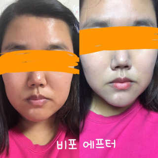 오오티유 45도 앵글 선코트 (with OOTU 앱) — 5점을 준 리뷰어가 2017년 11월 올린 사용 사진