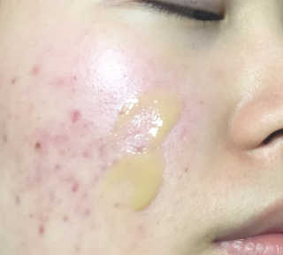 보타니티 [홍]조[진]정[결]케어 플라본 세럼 — 5점을 준 리뷰어가 2018년 5월 올린 사용 사진