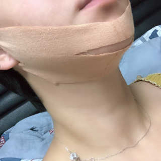 아이디플라코스메틱 아이디 페이스핏 마이너스 밴드 — 4점을 준 리뷰어가 2019년 9월 올린 사용 사진