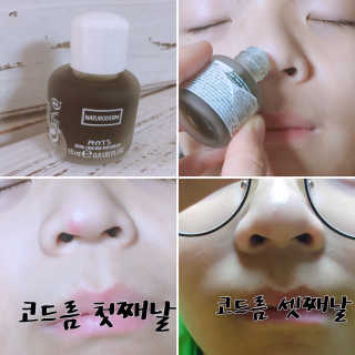아로마피츠 나튜로덤[트러블 스팟 앰플] — 5점을 준 리뷰어가 2019년 8월 올린 사용 사진