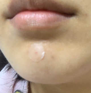 캐치미패치 트러블 스팟패치 — 5점을 준 리뷰어가 2019년 12월 올린 사용 사진