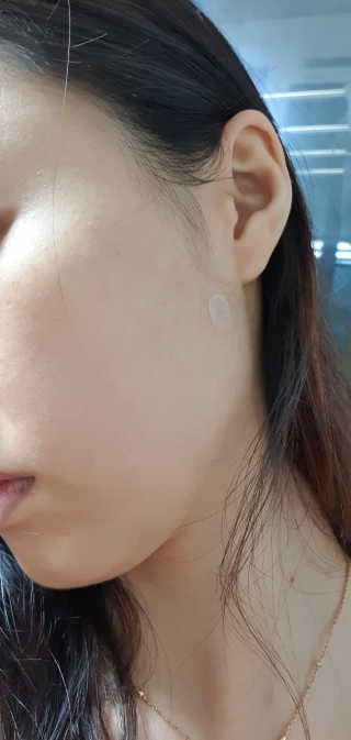 캐치미패치 트러블 스팟패치 — 5점을 준 리뷰어가 2020년 2월 올린 사용 사진