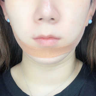 아이디플라코스메틱 아이디 페이스핏 마이너스 밴드 — 3점을 준 리뷰어가 2020년 4월 올린 사용 사진