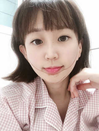 아이디플라코스메틱 아이디 페이스핏 마이너스 밴드 — 4점을 준 리뷰어가 2019년 11월 올린 사용 사진
