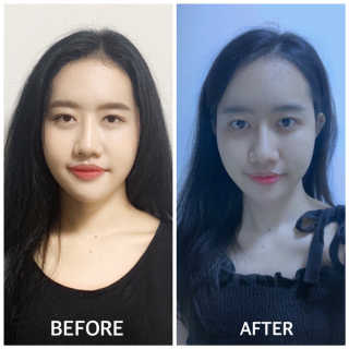 아이디플라코스메틱 아이디 페이스핏 마이너스 밴드 — 4.5점을 준 리뷰어가 2020년 3월 올린 사용 사진