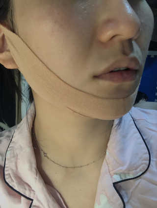 아이디플라코스메틱 아이디 페이스핏 마이너스 밴드 — 4점을 준 리뷰어가 2019년 11월 올린 사용 사진