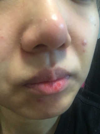 나이팅게일 TAKO PACK NOSE [문어코팩] — 2.17점을 준 리뷰어가 2017년 5월 올린 사용 사진