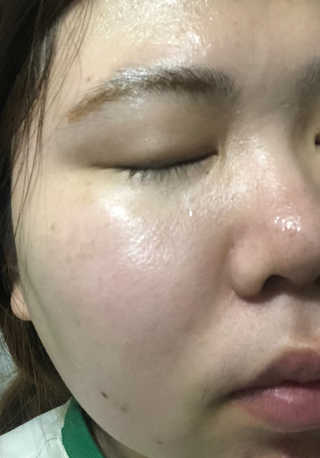 셀퓨전씨 트리악 포어 딜리트 버블 팩 — 5점을 준 리뷰어가 2018년 4월 올린 사용 사진