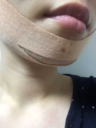 아이디플라코스메틱 아이디 페이스핏 마이너스 밴드 — 5점을 준 리뷰어가 2020년 3월 올린 사용 사진