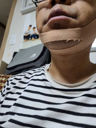아이디플라코스메틱 아이디 페이스핏 마이너스 밴드 — 5점을 준 리뷰어가 2020년 3월 올린 사용 사진